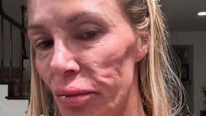 Read article: What is face collapse syndrome? Causes, effects and how to prevent it