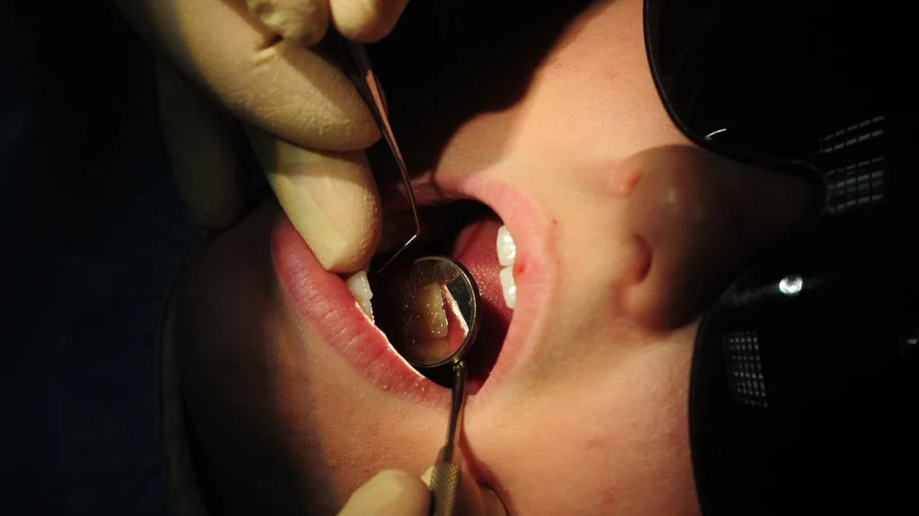 The truth about healing tooth decay naturally